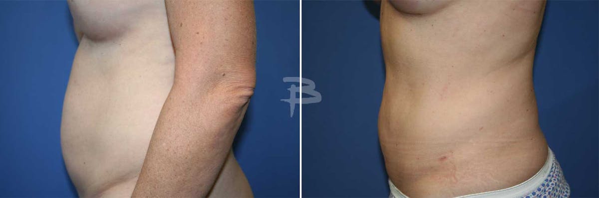 Liposuction Before & After Gallery - Patient 192277237 - Image 1