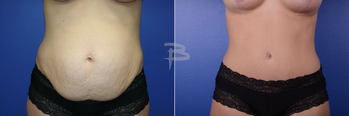 Abdominoplasty Before & After Gallery - Patient 192277239 - Image 1