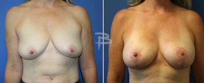 Breast Lift Before & After Gallery - Patient 192277240 - Image 1