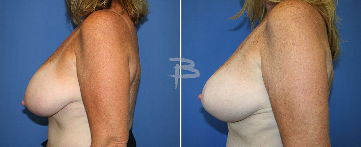 Breast Reduction Before & After Gallery - Patient 192277242 - Image 1