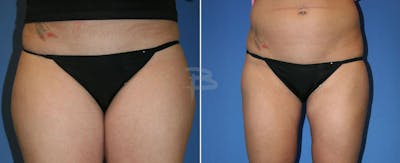 Liposuction Before & After Gallery - Patient 192277246 - Image 1