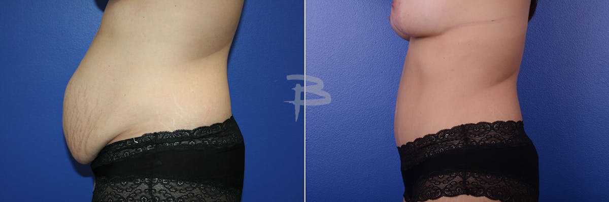 Abdominoplasty Before & After Gallery - Patient 192277250 - Image 1