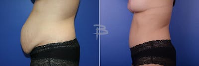 Abdominoplasty Before & After Gallery - Patient 192277250 - Image 1