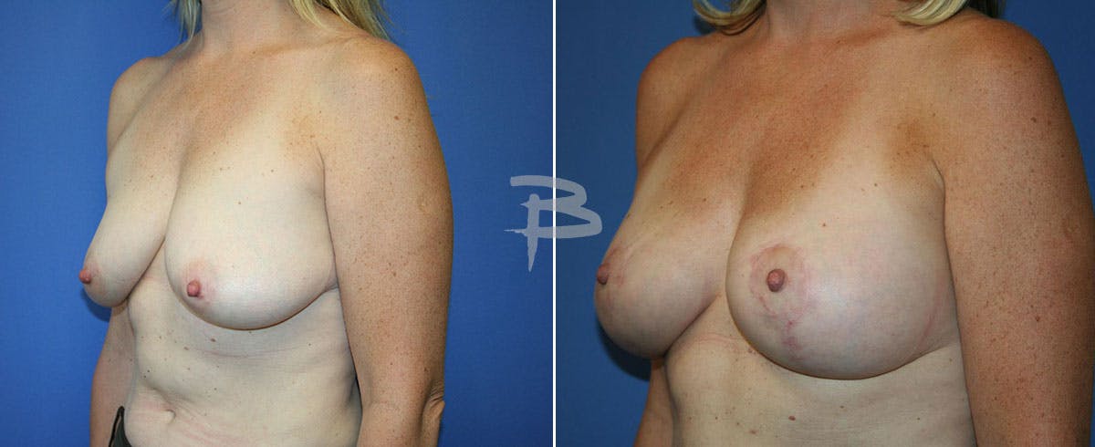 Breast Lift Before & After Gallery - Patient 192277252 - Image 1
