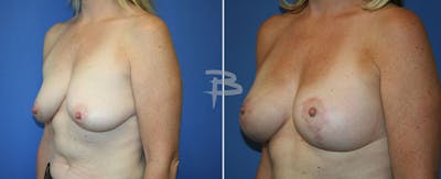 Breast Lift Before & After Gallery - Patient 192277252 - Image 1