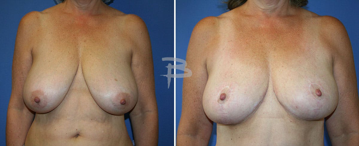 Breast Reduction Before & After Gallery - Patient 192277255 - Image 1