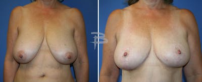 Breast Reduction Before & After Gallery - Patient 192277255 - Image 1
