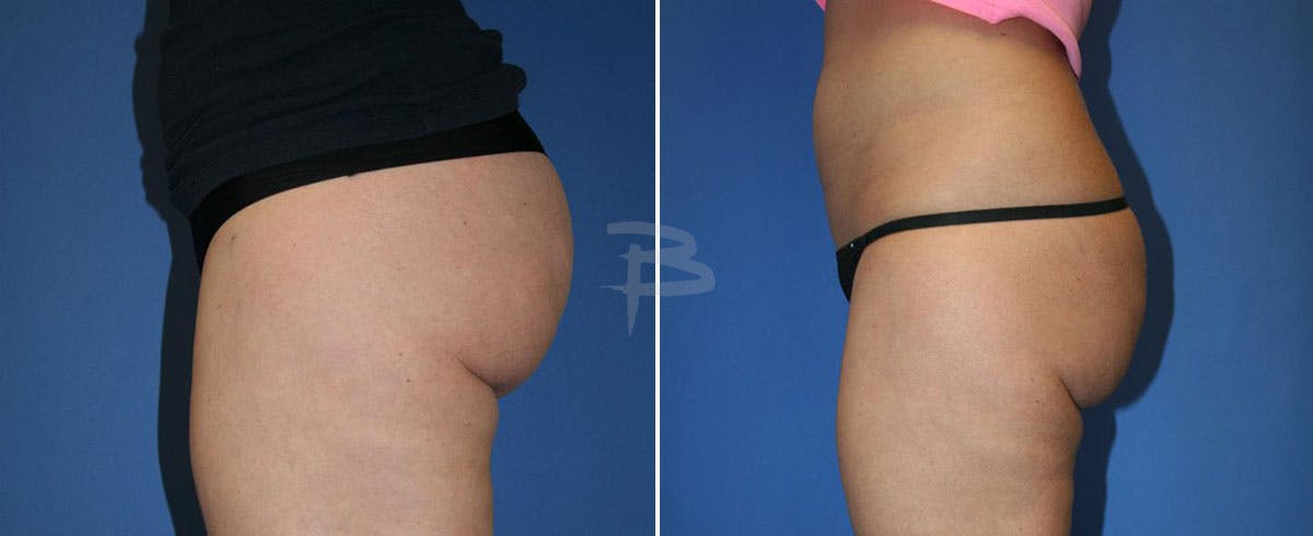 Liposuction Before & After Gallery - Patient 192277260 - Image 1
