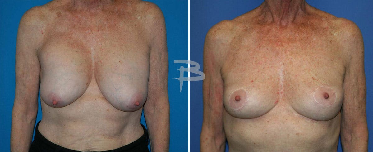 Breast Lift Before & After Gallery - Patient 192277267 - Image 1