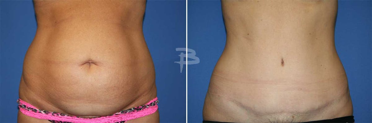 Abdominoplasty Before & After Gallery - Patient 192277263 - Image 1