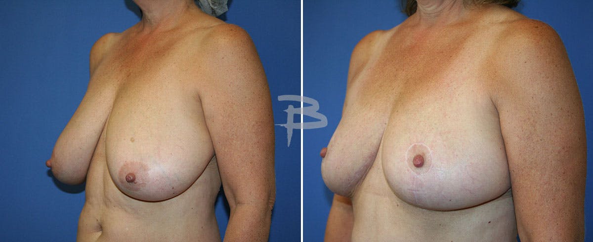 Breast Reduction Before & After Gallery - Patient 192277270 - Image 1