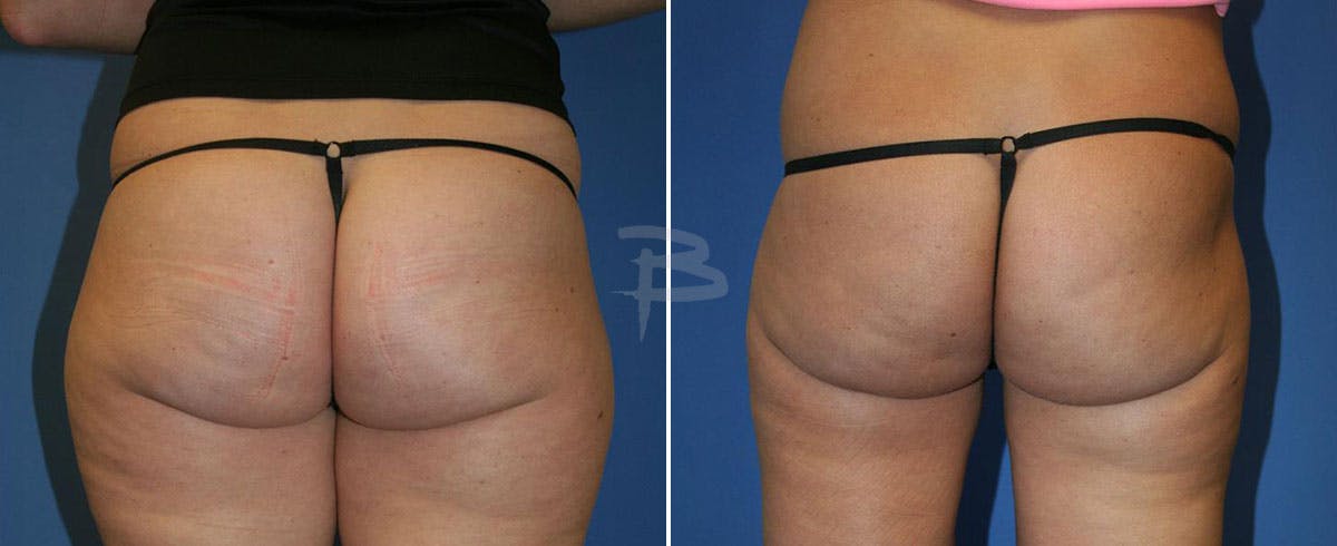 Liposuction Before & After Gallery - Patient 192277275 - Image 1