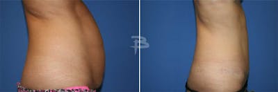 Abdominoplasty Before & After Gallery - Patient 192277279 - Image 1