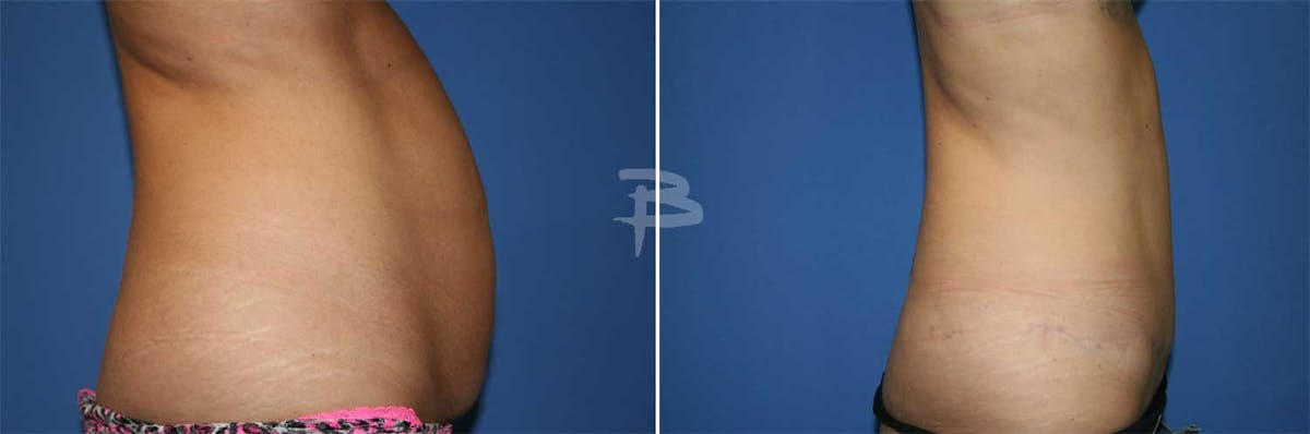 Abdominoplasty Before & After Gallery - Patient 192277279 - Image 1