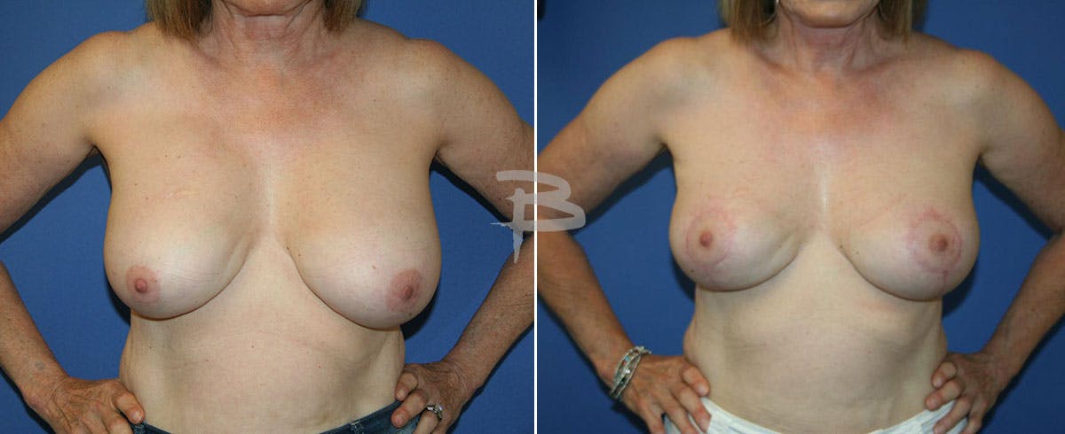 Breast Lift Before & After Gallery - Patient 192277285 - Image 1