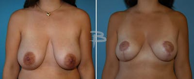 Breast Reduction Before & After Gallery - Patient 192277284 - Image 1