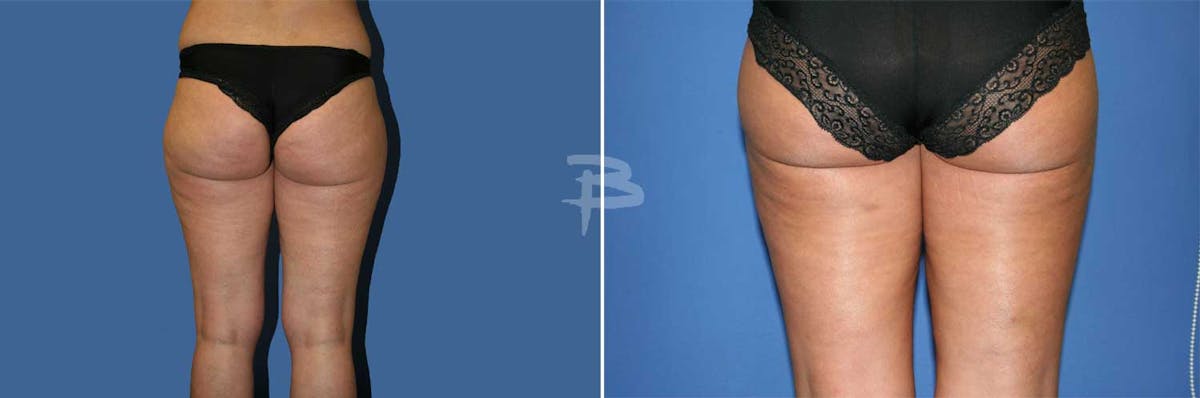 Liposuction Before & After Gallery - Patient 192277288 - Image 1
