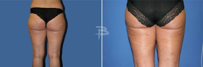 Liposuction Before & After Gallery - Patient 192277288 - Image 1