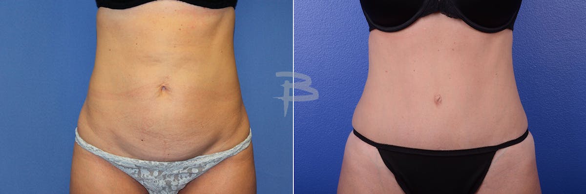 Abdominoplasty Before & After Gallery - Patient 192277294 - Image 1