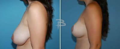 Breast Reduction Before & After Gallery - Patient 192277298 - Image 1
