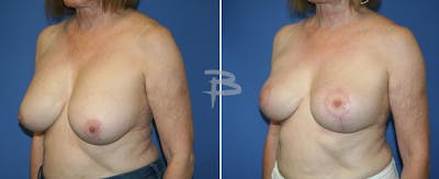 Breast Lift Before & After Gallery - Patient 192277300 - Image 1