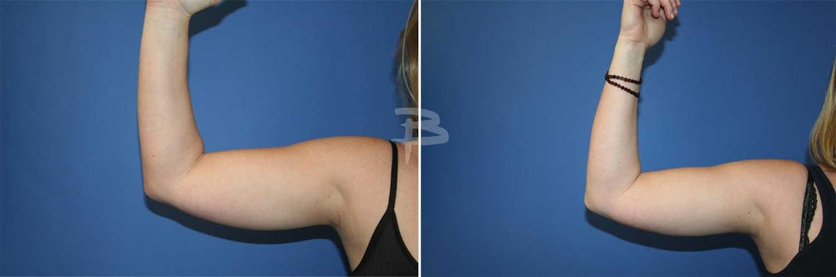 Liposuction Before & After Gallery - Patient 192277303 - Image 1