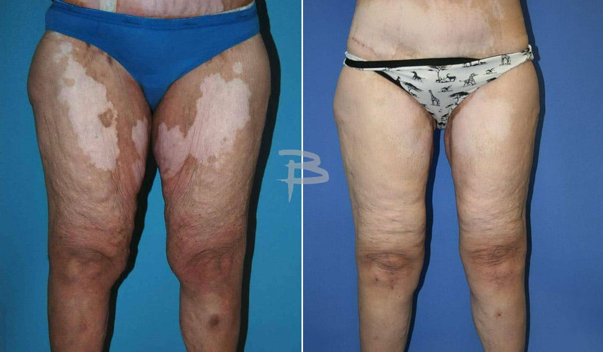 Thigh Lift Before & After Gallery - Patient 192277302 - Image 1