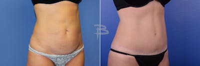 Abdominoplasty Before & After Gallery - Patient 192277308 - Image 1