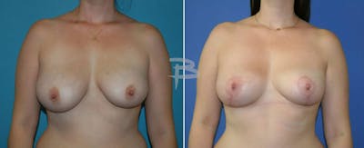 Breast Lift Before & After Gallery - Patient 192277309 - Image 1