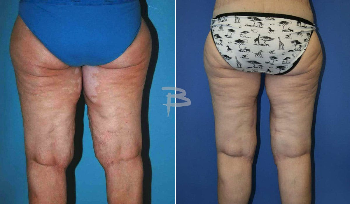 Thigh Lift Before & After Gallery - Patient 192277312 - Image 1