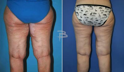 Thigh Lift Before & After Gallery - Patient 192277312 - Image 1