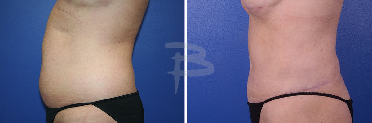 Abdominoplasty Before & After Gallery - Patient 192277323 - Image 1