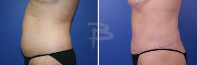 Abdominoplasty Before & After Gallery - Patient 192277323 - Image 1