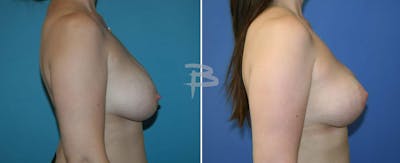 Breast Lift Before & After Gallery - Patient 192277320 - Image 1