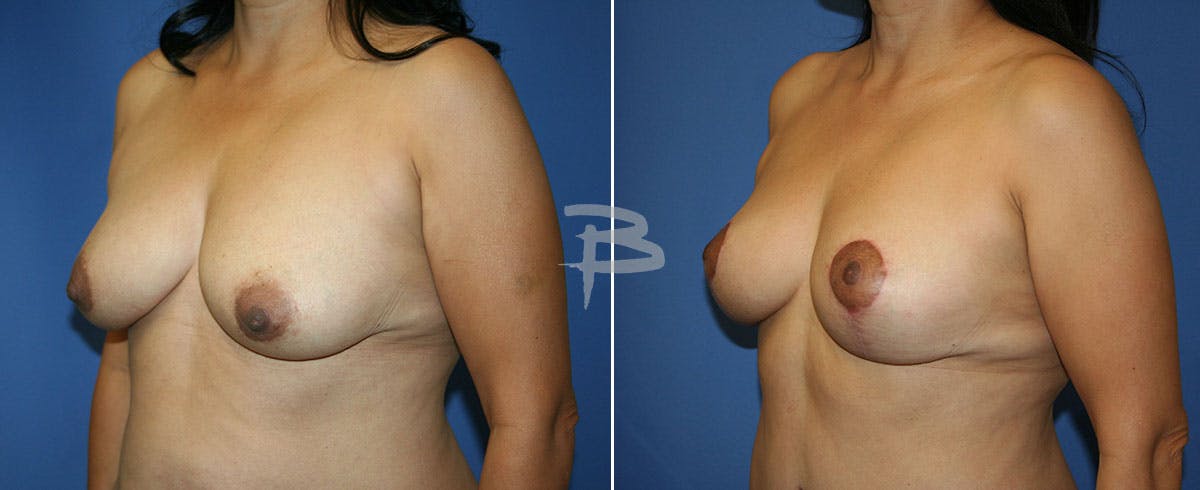 Breast Lift Before & After Gallery - Patient 192277332 - Image 1