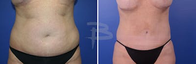Abdominoplasty Before & After Gallery - Patient 192277334 - Image 1