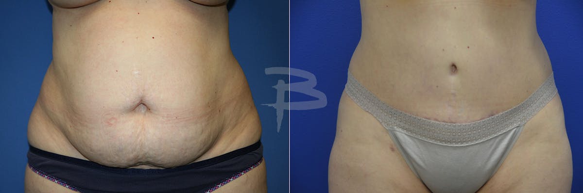 Abdominoplasty Before & After Gallery - Patient 192277345 - Image 1