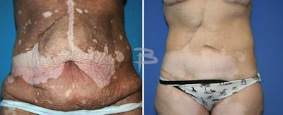 Body Contouring After Weight Loss Before & After Gallery - Patient 192277350 - Image 1