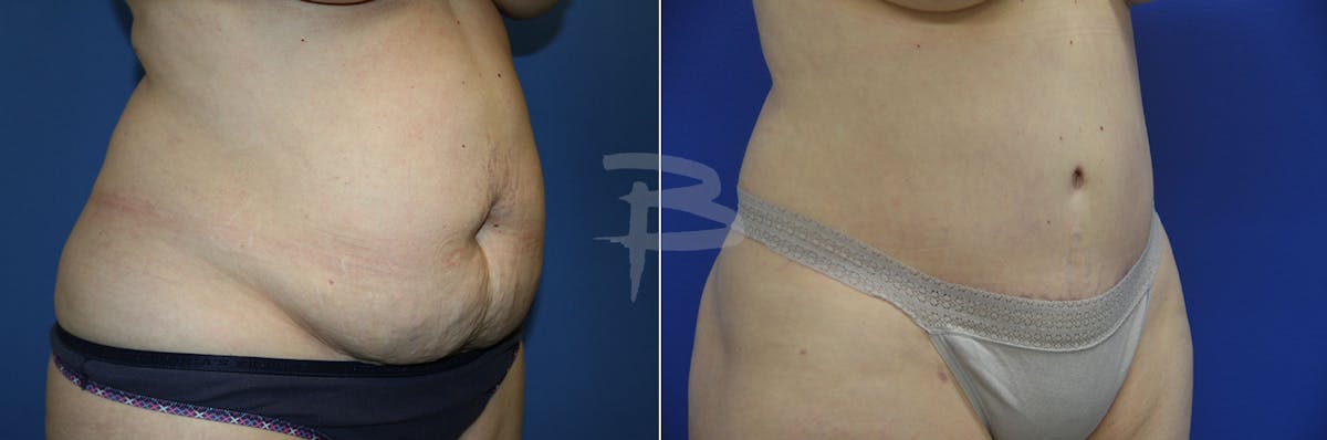 Abdominoplasty Before & After Gallery - Patient 192277356 - Image 1