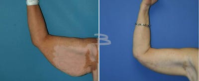 Body Contouring After Weight Loss Before & After Gallery - Patient 192277359 - Image 1