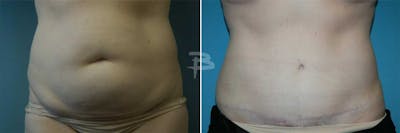 Abdominoplasty Before & After Gallery - Patient 192277364 - Image 1