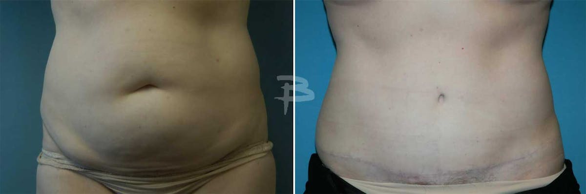Abdominoplasty Before & After Gallery - Patient 192277364 - Image 1