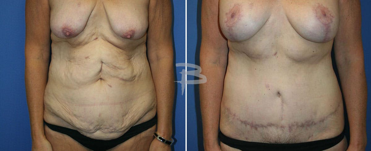 Body Contouring After Weight Loss Before & After Gallery - Patient 192277375 - Image 1
