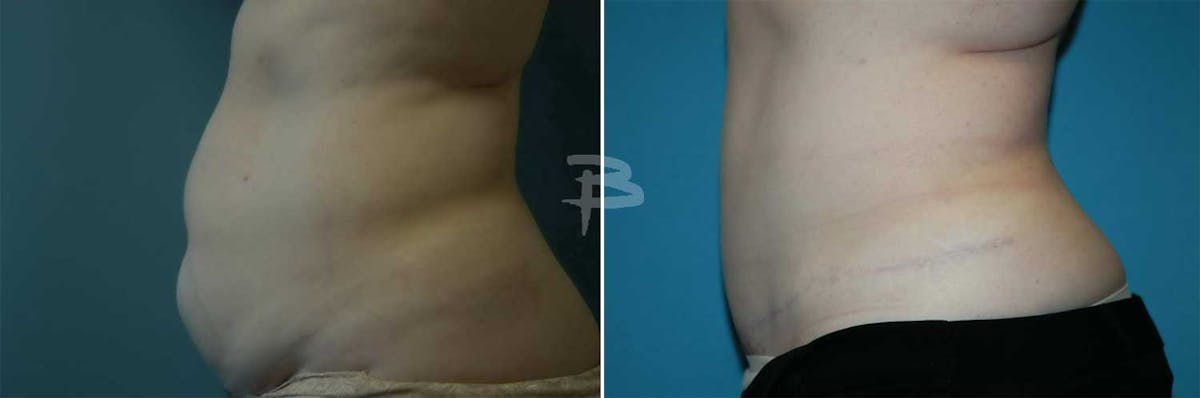 Abdominoplasty Before & After Gallery - Patient 192277379 - Image 1