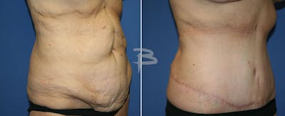Body Contouring After Weight Loss Before & After Gallery - Patient 192277387 - Image 1