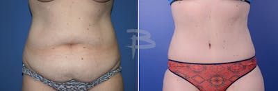 Abdominoplasty Before & After Gallery - Patient 192277394 - Image 1