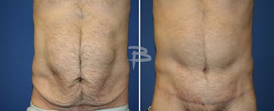 Body Contouring After Weight Loss Before & After Gallery - Patient 192277402 - Image 1