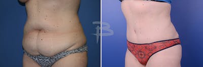 Abdominoplasty Before & After Gallery - Patient 192277406 - Image 1