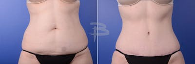 Abdominoplasty Before & After Gallery - Patient 192277418 - Image 1