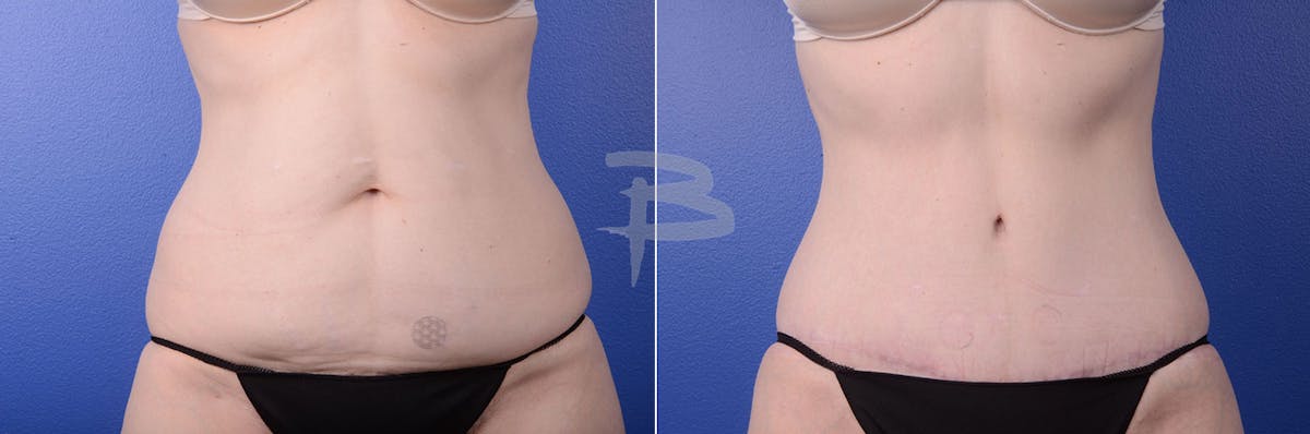Abdominoplasty Before & After Gallery - Patient 192277418 - Image 1